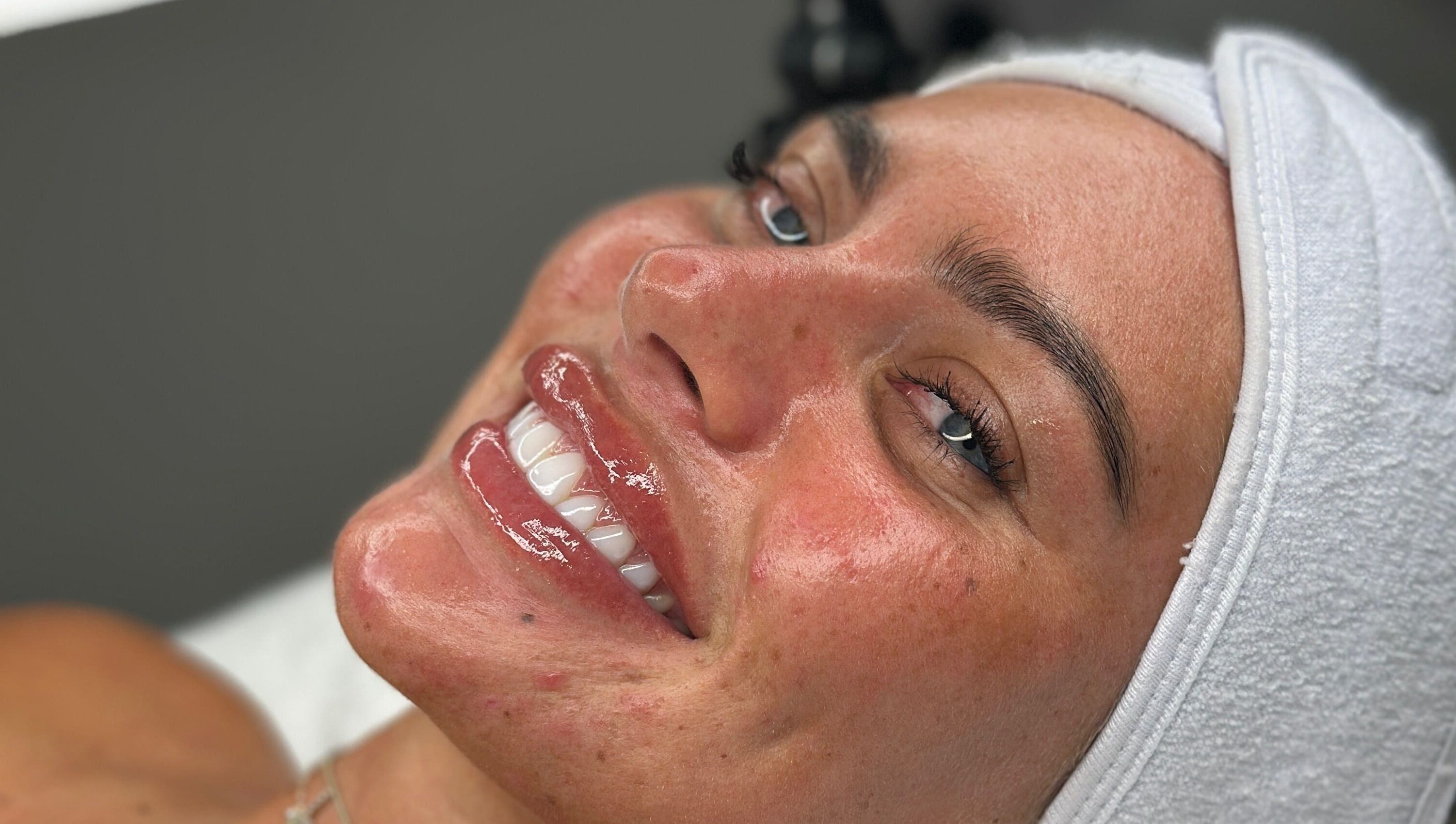 Glowing skin treatment at Derma Touch Skin Clinic, Widnes, England, GB.