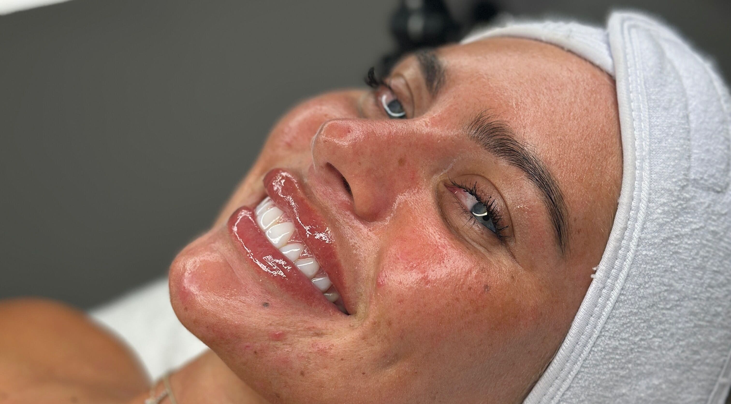 Glowing skin treatment at Derma Touch Skin Clinic, Widnes, England, GB.