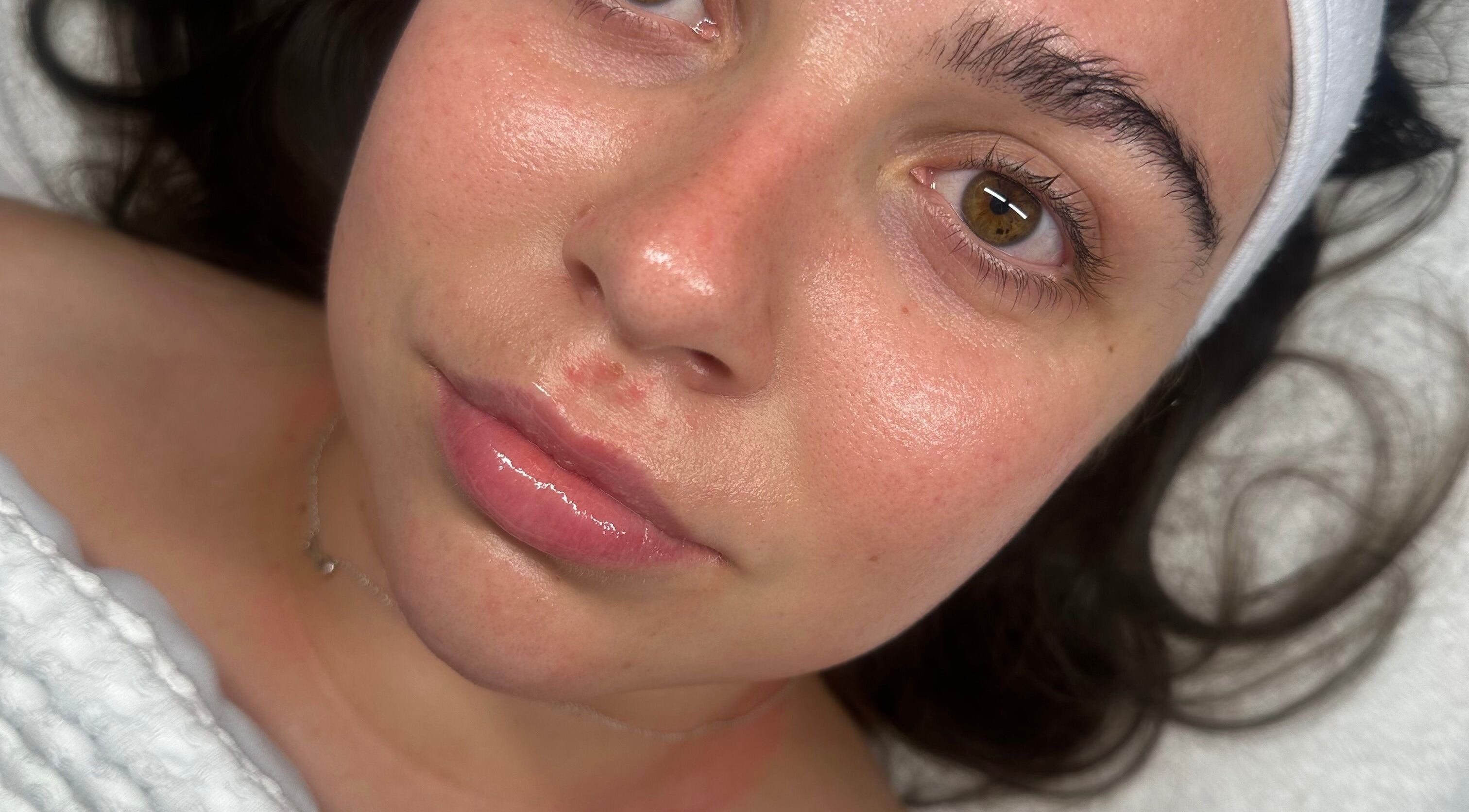 Close-up of a woman's glowing skin after treatment at Derma Touch Skin Clinic in Widnes, England, GB.