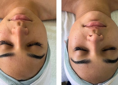 Before and after skin treatment at Naked Lumina Skin + Esthetics in Houston, Texas, US showing enhanced complexion.