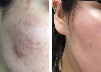 Before and after acne treatment at Skintude, Ahmedabad, Gujarat, IN, showcasing clear skin results.