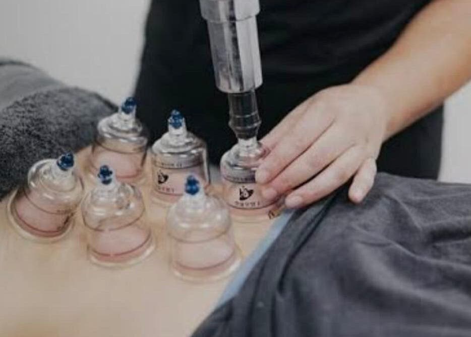 Cupping therapy session at Living Well Massage Town Hall, Sydney, New South Wales, AU.