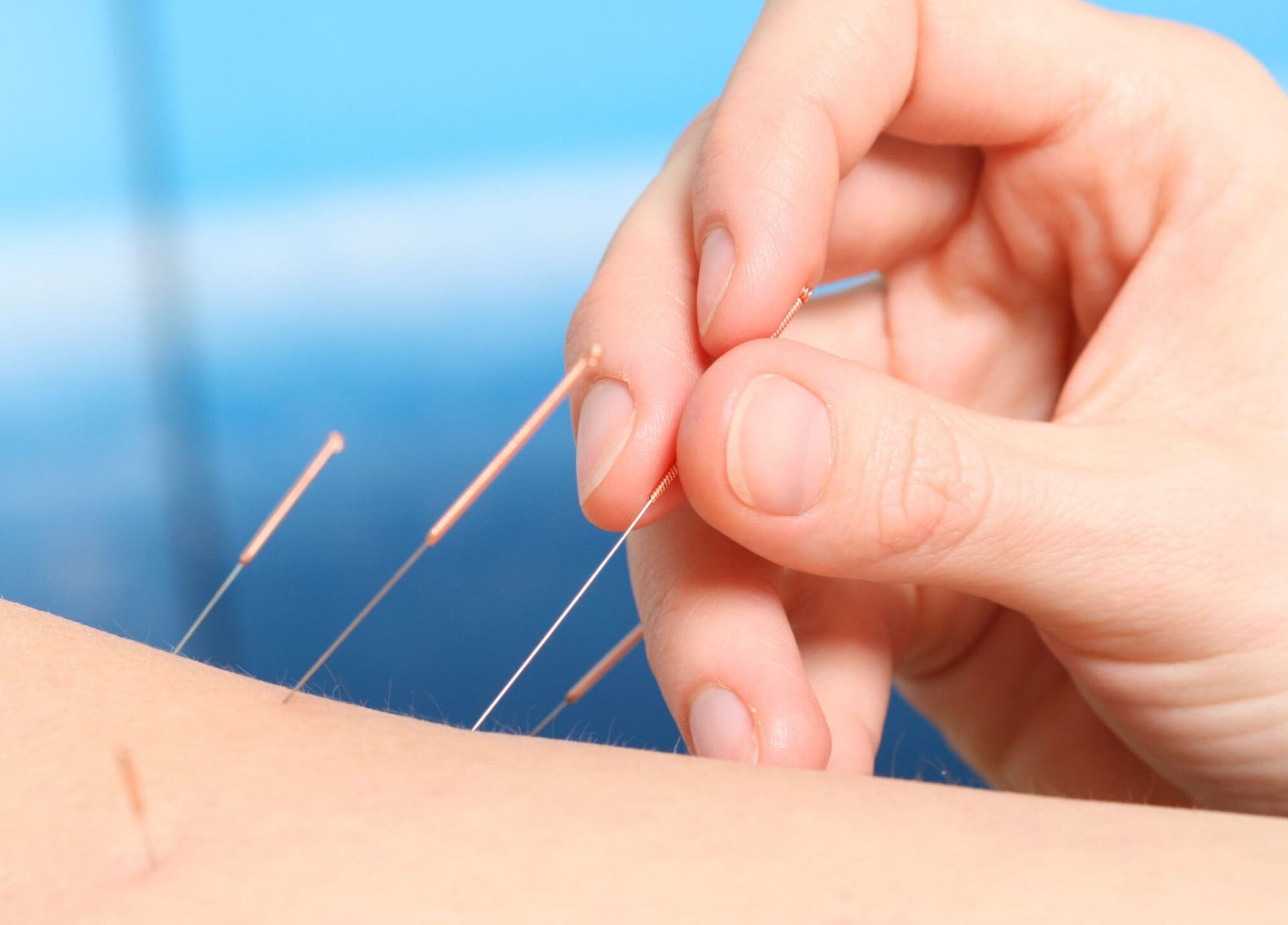 Acupuncture therapy at Living Well Massage Town Hall, Sydney, New South Wales, AU promotes relaxation.