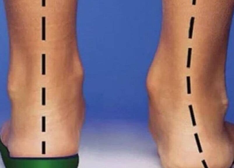 Сравнение на крака, показва корекция в ОРТОПЕДИЧЕН МАГАЗИН Vi Step, Пловдив, Пловдив, BG.