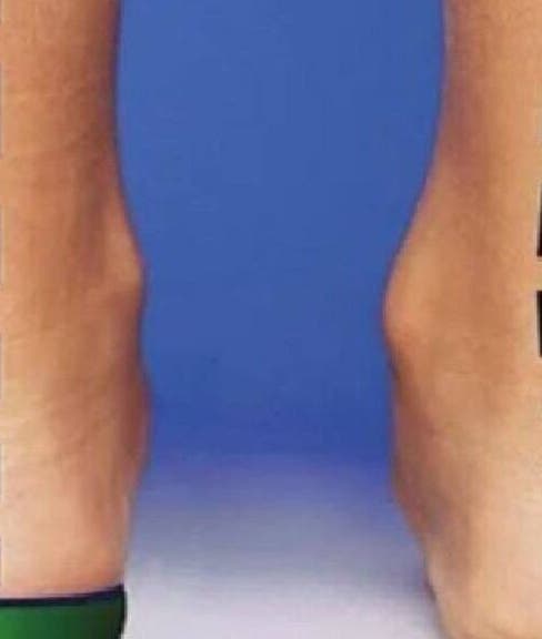 Сравнение на крака, показва корекция в ОРТОПЕДИЧЕН МАГАЗИН Vi Step, Пловдив, Пловдив, BG.