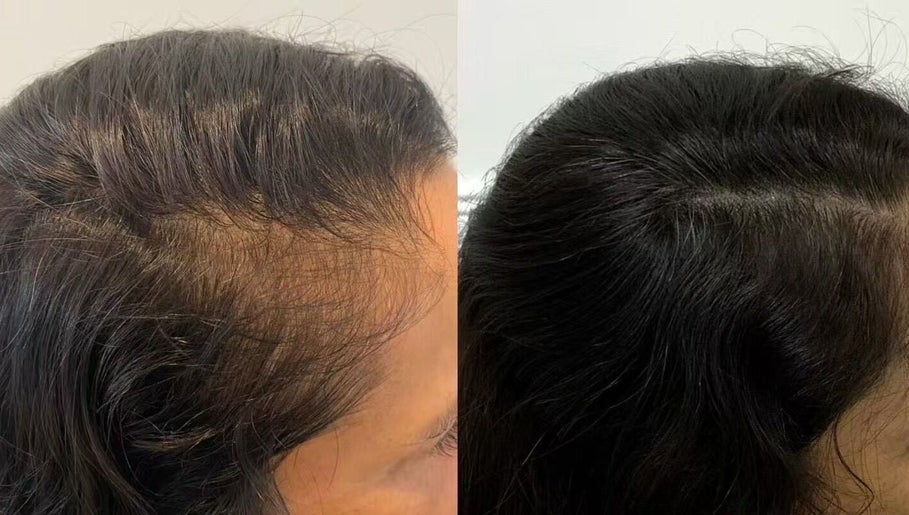 Before and after hair treatment at Skin Theory Cosmedics, O'Connor, Australian Capital Territory, AU.