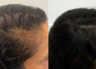 Before and after hair treatment at Skin Theory Cosmedics, O'Connor, Australian Capital Territory, AU.