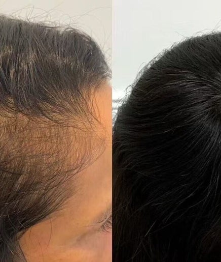 Before and after hair treatment at Skin Theory Cosmedics, O'Connor, Australian Capital Territory, AU.