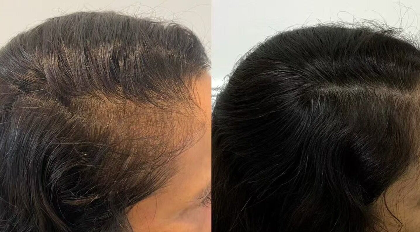 Before and after hair treatment at Skin Theory Cosmedics, O'Connor, Australian Capital Territory, AU.
