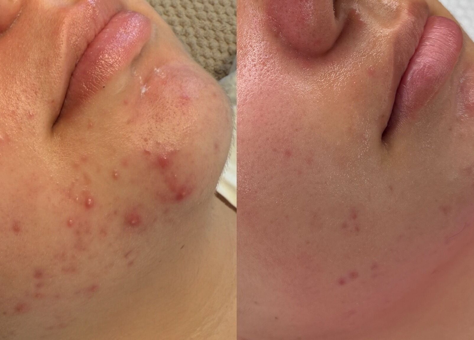 Acne treatment results at HYDRASKIN STUDIO, London, England, GB, showing skin clarity improvement.