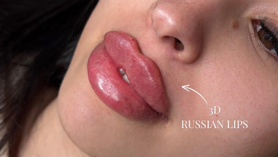 3D Russian lips enhancement at Kissed Clinic - Harlow, Harlow, England, GB, showcasing glossy full lips.