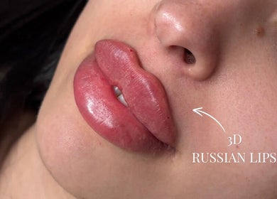 3D Russian lips enhancement at Kissed Clinic - Harlow, Harlow, England, GB, showcasing glossy full lips.