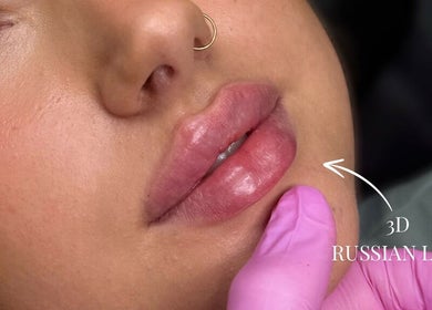Close-up of perfectly plump lips at Kissed Clinic - Harlow, enhancing beauty in Harlow, England, GB.