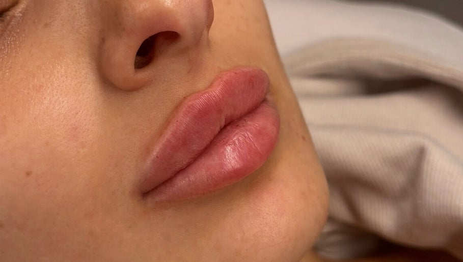 Close-up of lips after treatment at Kissed Clinic - Wilmslow, Wilmslow, England, GB, showcasing smooth results.