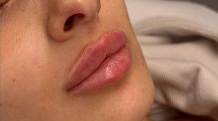 Close-up of lips after treatment at Kissed Clinic - Wilmslow, Wilmslow, England, GB, showcasing smooth results.