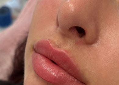 Elegant lip enhancement at Kissed Clinic - Wilmslow, showcasing glossy lips. Location: Wilmslow, England, GB.