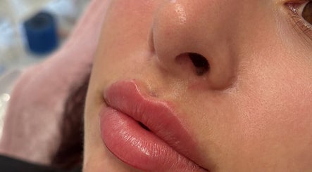 Elegant lip enhancement at Kissed Clinic - Wilmslow, showcasing glossy lips. Location: Wilmslow, England, GB.