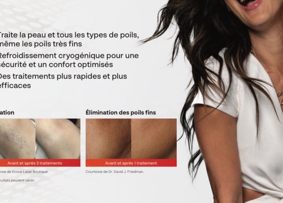 Traitement épilation avancé chez Beauté par Kristine, Laval, Québec, CA. Rapidité et efficacité garanties.