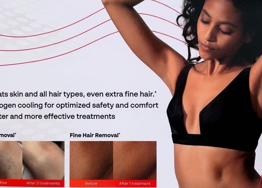 Traitements d'épilation avancés chez Beauté par Kristine, Laval, Québec, CA, affichant résultats avant-après.