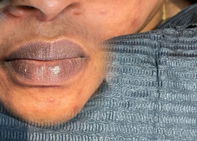 Close-up of shimmering lips receiving treatment at LabtoLips, Halstead, England, GB.
