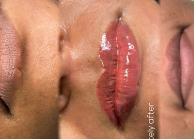 Lip enhancement results at Labtolips Chelmsford, Chelmsford, England, GB, displaying before and after treatments.
