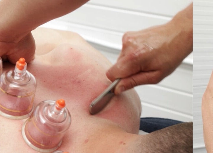 Cupping therapy at 360 Healthcare Hub, Wigan, England, GB, offers holistic wellness treatment.