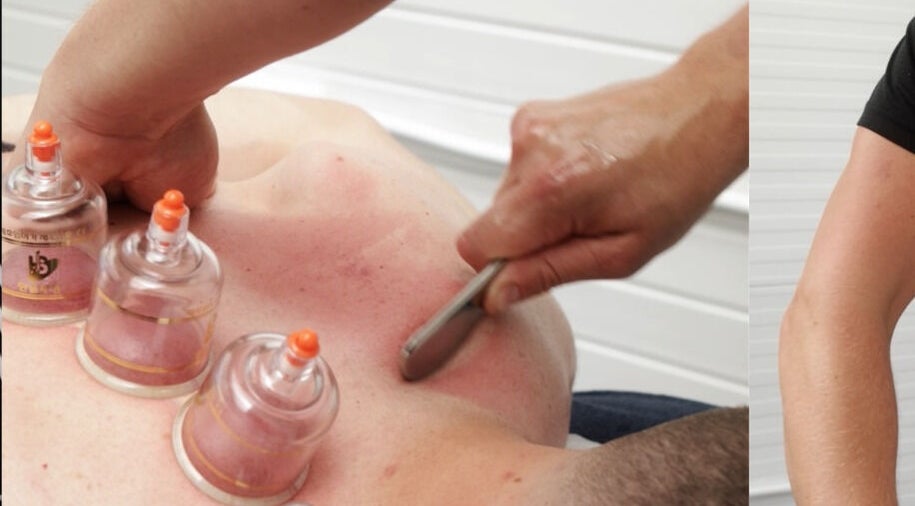 Cupping therapy at 360 Healthcare Hub, Wigan, England, GB, offers holistic wellness treatment.