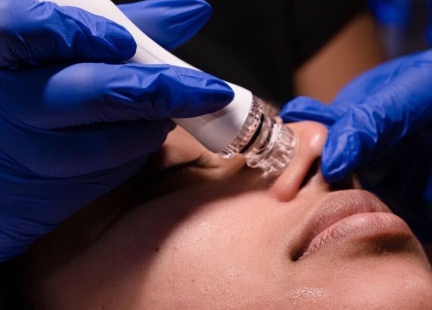 HydraFacial treatment at Dr Avinash Nath Maraval Office, Port Of Spain, Diego Martin Regional Corporation, TT.