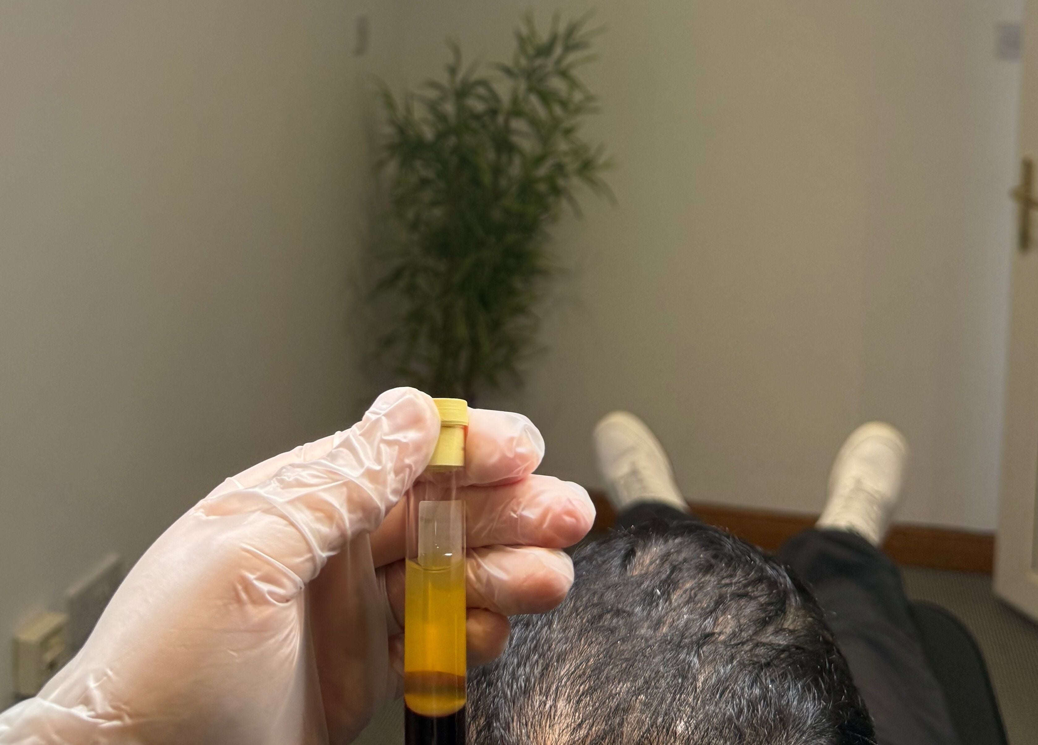 Hair treatment at Revitaglow Aesthetics and Wellness, Derby, England, GB, showing a vial in focus.