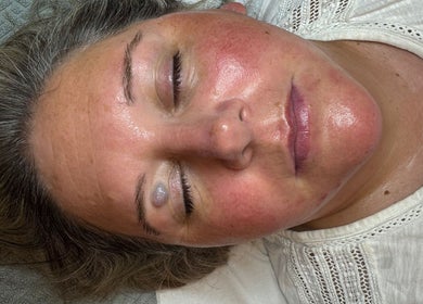 Woman receiving skincare treatment at Luminous Skin Clinic, Letterkenny, County Donegal, IE.