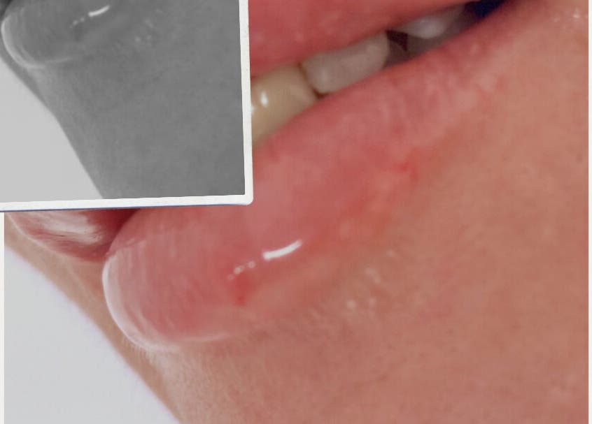 Close-up of glossy lips after treatment at Love Mi Aesthetics, Weymouth, England, GB.