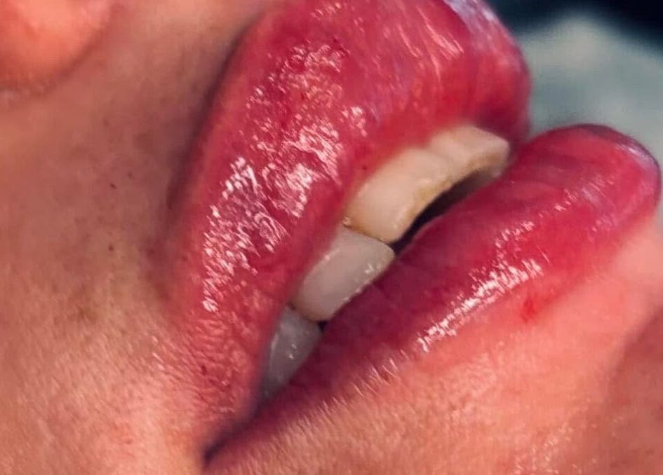 Close-up of glossy, enhanced lips at Love Mi Aesthetics, Weymouth, England, GB.