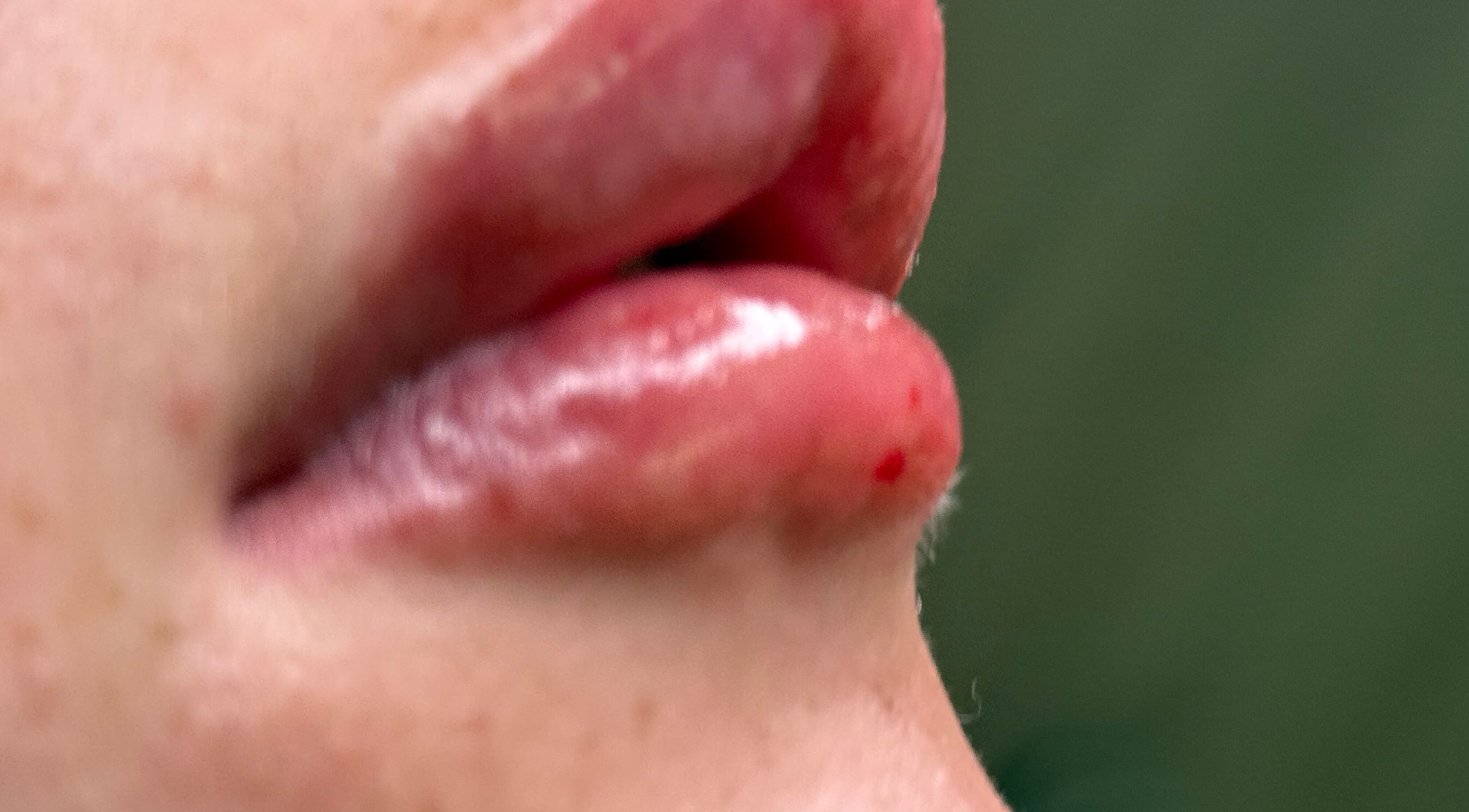 Plump, glossy lips at Love Mi Aesthetics, Weymouth, England, GB. Perfect lip enhancement services.