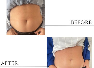 Before images of body transformation at Shape & Sculpt with Grace, Liverpool, England, GB.