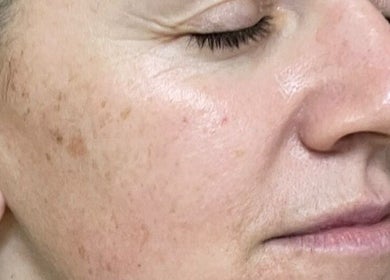 Close-up of rejuvenated skin after treatment at HayanSkin - Korean Skincare Beauty Studio, Ashmore, Queensland, AU.