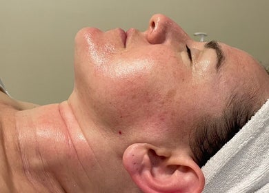 Glowing skin after facial at HayanSkin - Korean Skincare Beauty Studio in Ashmore, Queensland, AU.