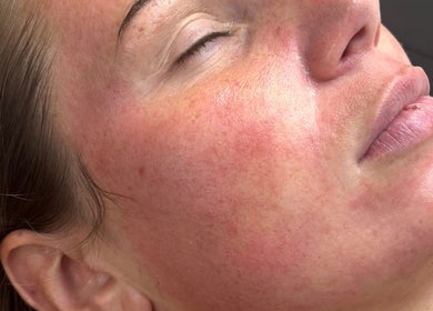 Close-up of refreshed skin after treatment at Ally’s Aesthetics, Glasgow, Scotland, GB.