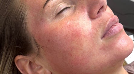 Close-up of refreshed skin after treatment at Ally’s Aesthetics, Glasgow, Scotland, GB.