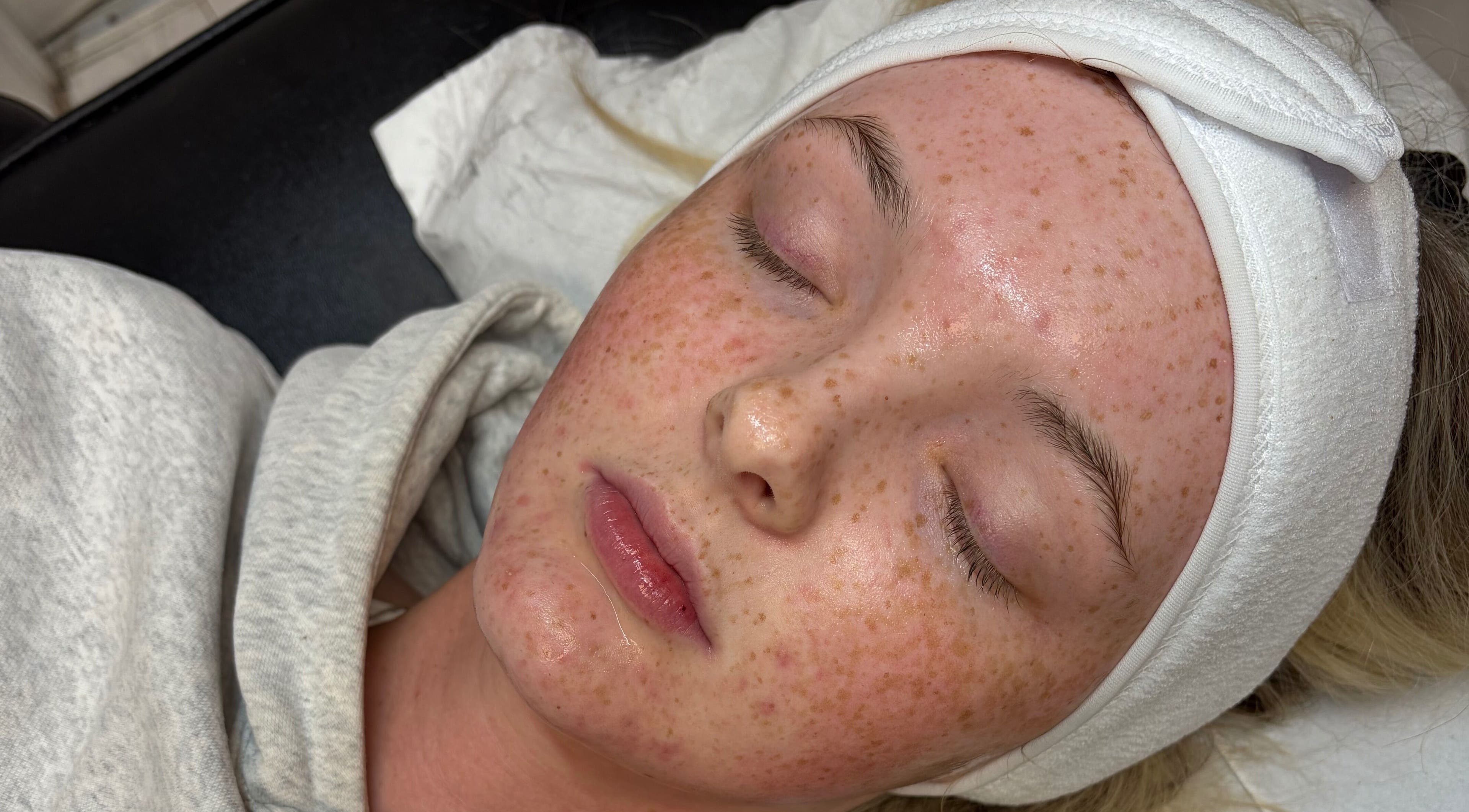 Relaxing facial treatment at Ally’s Aesthetics, Glasgow, Scotland, GB, showcasing flawless skincare results.