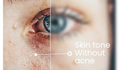 Close-up of skin transformation at Girls Only Cosmetics by Alina Nisnik, Ra'anana, Center District, IL.