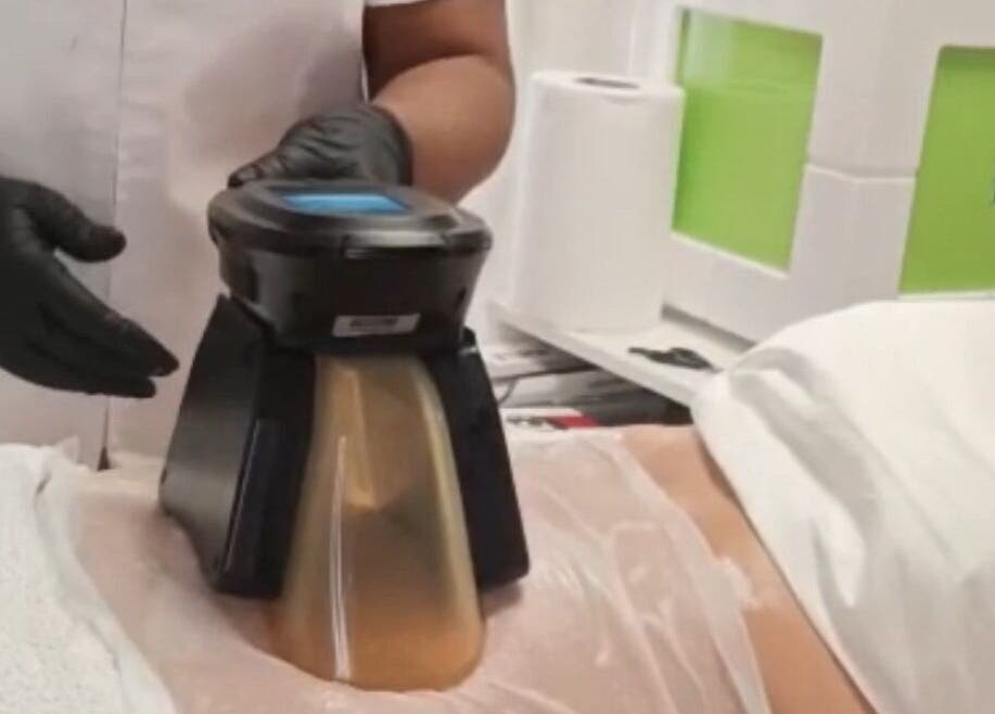 Procedimiento estético en Advanced Aesthetics VM, Villamartín, Comunidad Valenciana, ES.