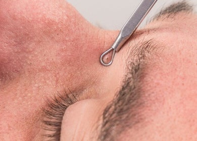 Tratamiento facial en Vela Clinic, Barcelona, Cataluña, ES. Extracción profesional de impurezas.