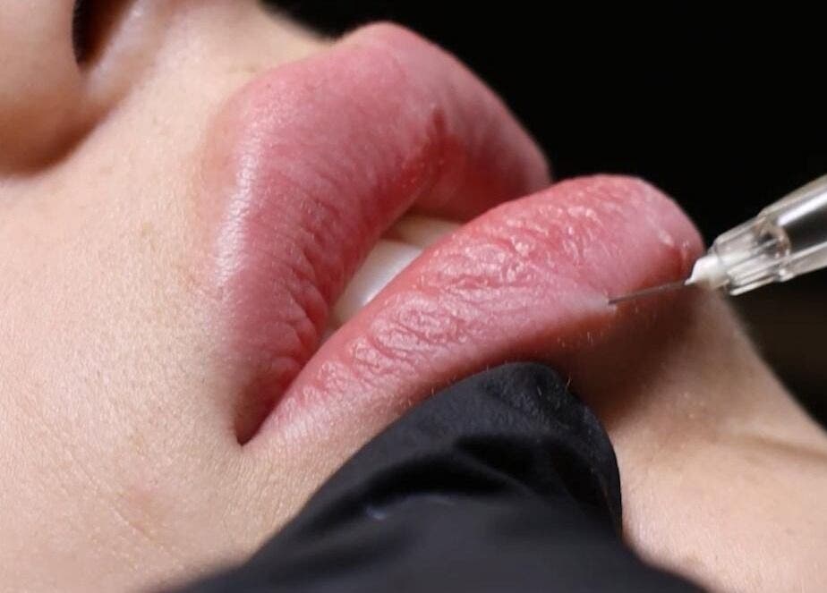 Tratamento labial na Bodyglow, Leça Da Palmeira, Porto, PT, destacando injeção para aumento de volume.