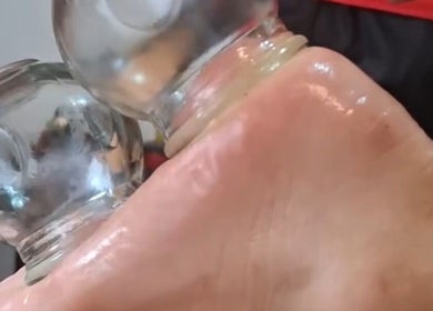 Cupping alami di Massage Oil Home Spa, Kalimantan Tengah, Kalimantan Tengah, ID.