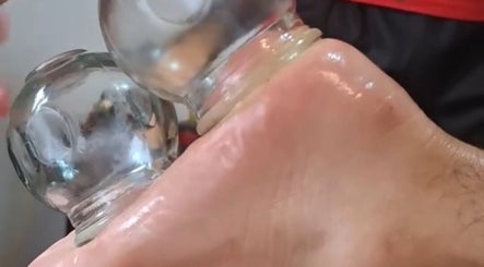 Cupping alami di Massage Oil Home Spa, Kalimantan Tengah, Kalimantan Tengah, ID.