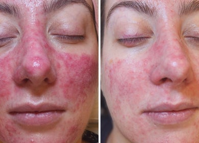 Before and after skincare treatment at Skin and Sculpt by Victoria Cottle, Honiton, England, GB.