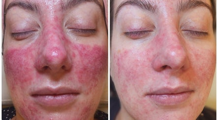 Before and after skincare treatment at Skin and Sculpt by Victoria Cottle, Honiton, England, GB.