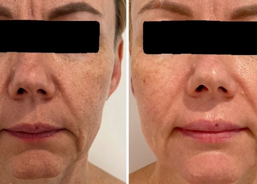 Before and after facial treatment at Dotyk Beauty Therapy, London, England, GB showing improved skin texture.