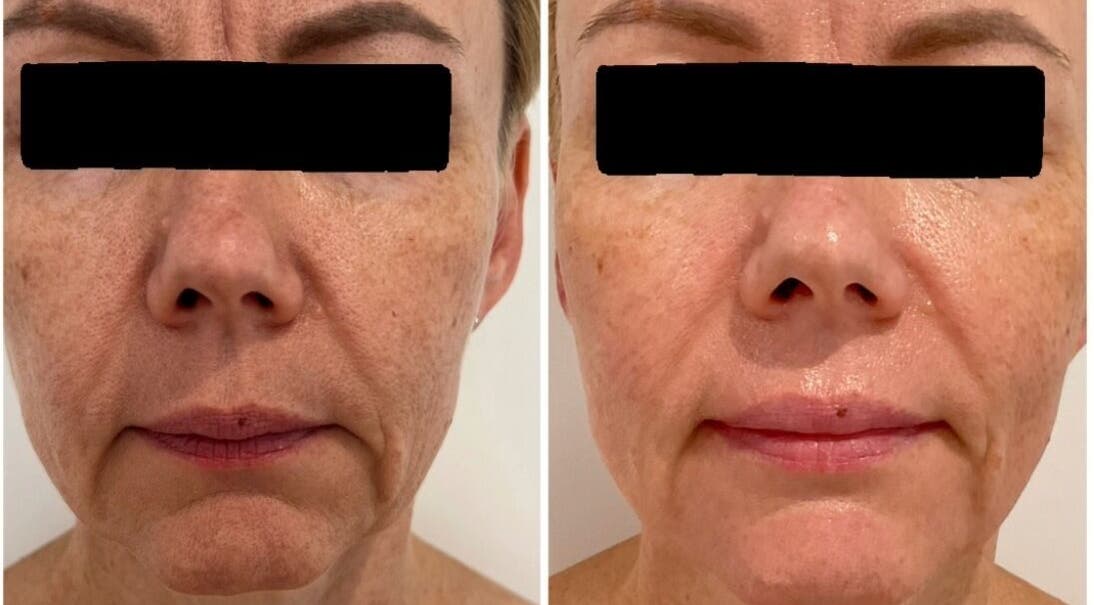 Before and after facial treatment at Dotyk Beauty Therapy, London, England, GB showing improved skin texture.