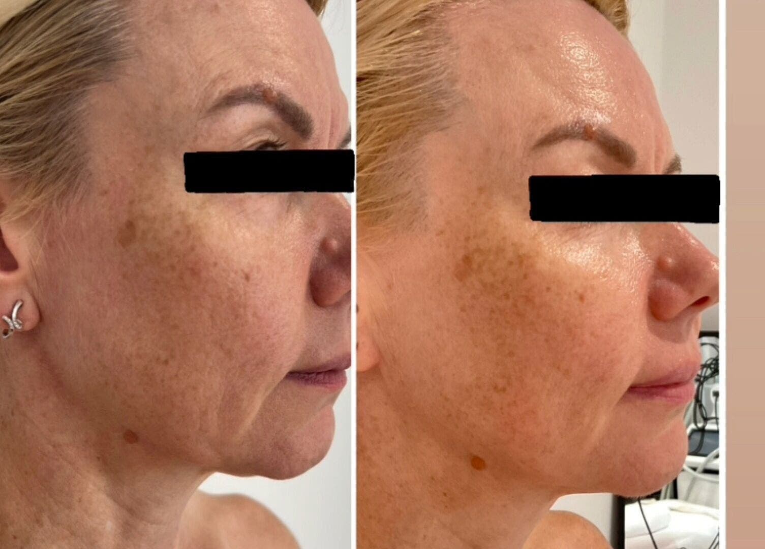 Before and after skin treatment at Dotyk Beauty Therapy, London, England, GB showcasing remarkable results.